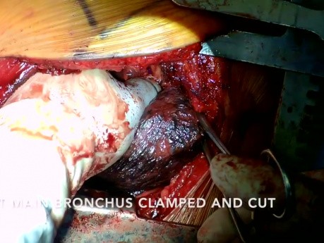 Left Pneumonectomy for Non-Small Cell Lung Cancer