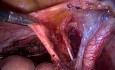 Excision of Pelvic Lymph Nodes