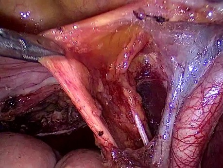 Excision of Pelvic Lymph Nodes