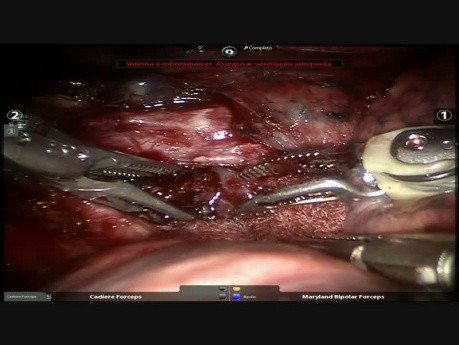 S2 - Anatomic Segmentectomy, Robotic Surgery