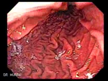 Gastric Folds 1