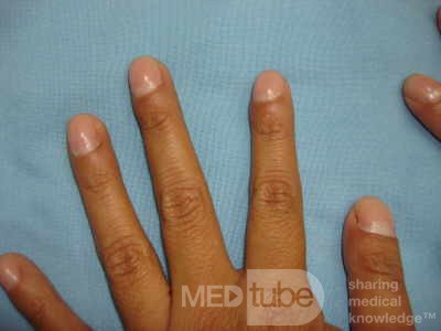 Esophagus - Pneumatic Dilation for Achalasia (23 of 31)