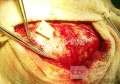 Acute Spontaneous Subdural Hemorrhage in the Subdural Space