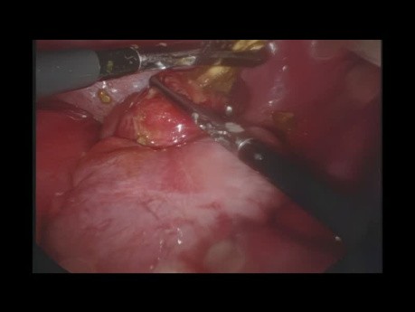 Laparoscopic Removal of a Perforated Foreign Body Mimicking Acute Perforated Appendicitis