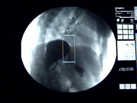 Esophageal Obstruction - Fluoroscopic View