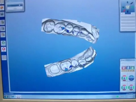 Lunch Date - CEREC AC - e.max Crown #31 Scan and Mill