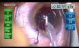 Cataract Surgery with Metrics for Learning Cataract Surgery