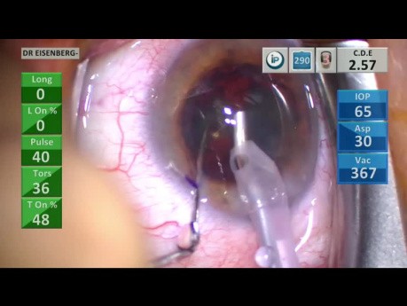 Cataract Surgery with Metrics for Learning Cataract Surgery