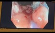 EMR Carpetlike Rectal Polyp