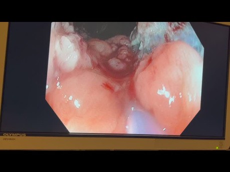 EMR Carpetlike Rectal Polyp