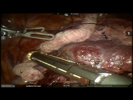 Right Upper Lobectomy - Post Neoadjuvancy