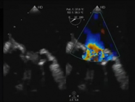 A Case: Infective Endocarditis of a Prosthetic Mitral Valve Transesophageal Echocardiography