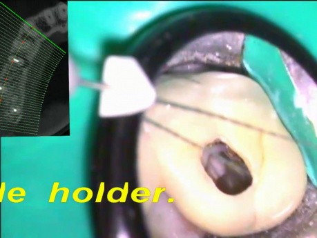Missed palatal root