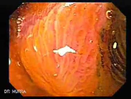 Barrett Esophagus - endoscopic view  (6 of 9)