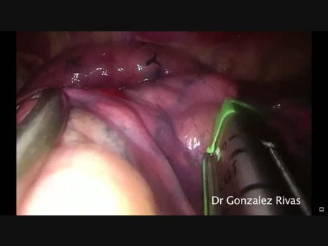 Uniportal VATS Left Upper Anterior Segmentectomy (Segment 3)