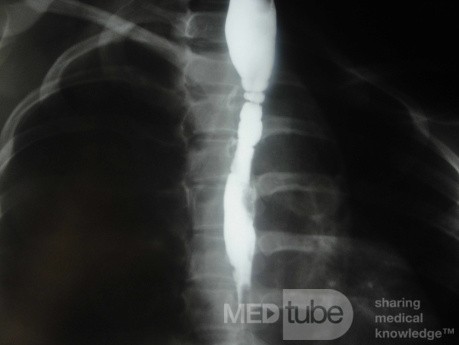 Congenital Esophageal Rings (5 of 5)