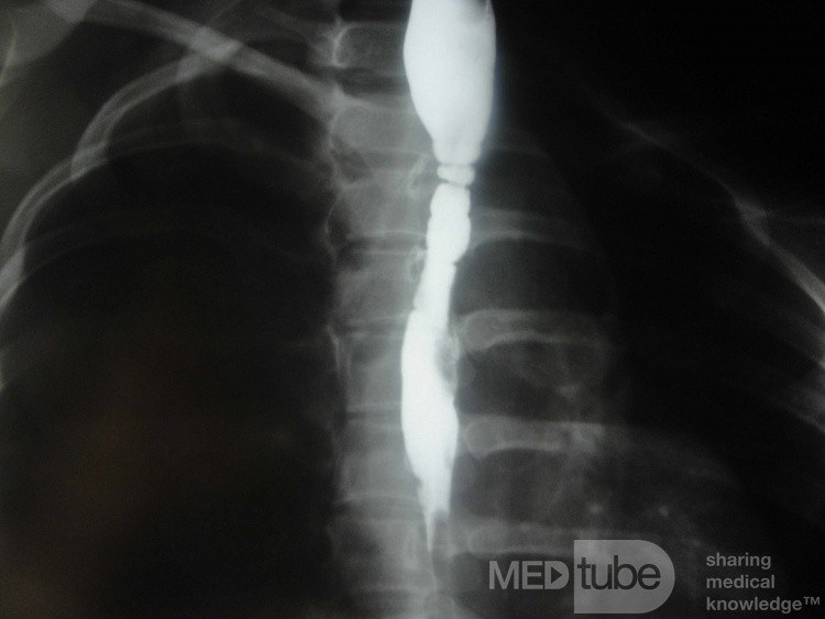 Congenital Esophageal Rings (5 of 5)