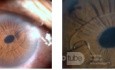 Xfoliation and Iris Claw Lens