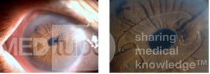 Xfoliation and Iris Claw Lens