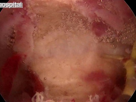 Resection of Patological Septum by Use of Hysteroscopy