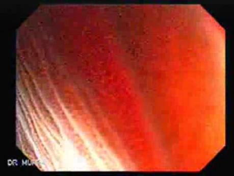 Melanosis Coli (4 of 5)