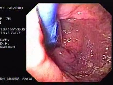 Esophageal Achalasia (10 of 16)