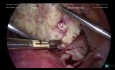 Anterior Cervical Fibroid