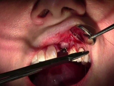 Suturing Technique - Implant Placement #9