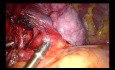 Subxiphoid Uniportal Complex Middle Lobectomy (Fused Artery)