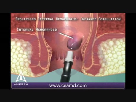 Infrared Coagulation Therapy for Hemorrhoids - 3D Medical Animation