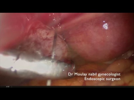 Corpus Luteum Hemorrhage Management