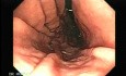 Endoscopy of stomach and duodenum