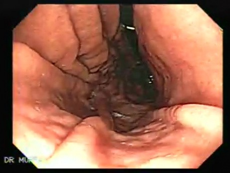 Endoscopy of stomach and duodenum