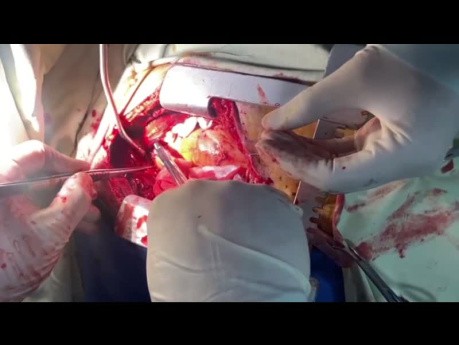 Aortic Stump Perforation Management after MVR in ICU OH
