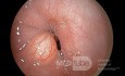 Granular Cell Tumor Of The Distal Esophagus