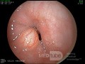Granular Cell Tumor Of The Distal Esophagus