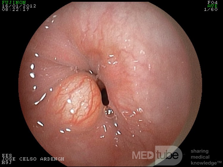 Granular Cell Tumor Of The Distal Esophagus