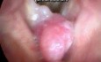 The Sessile-Based True Vocal Fold Polyp-Spontaneous Movements upon Respiration