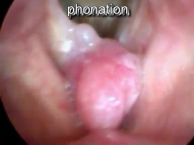 The Sessile-Based True Vocal Fold Polyp-Spontaneous Movements upon Respiration
