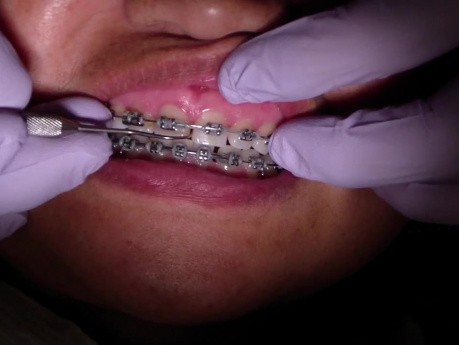 Powerchain - Ortho Update (Patient Mr)