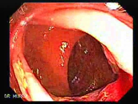 Ascending Colon Cancer (5 of 6)