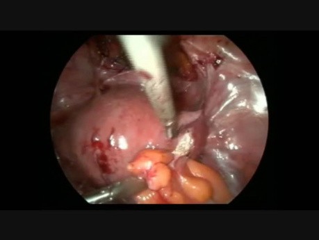 Laparoscopic Hysterectomy With Severe Adhesion