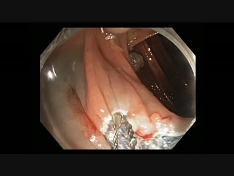 Colonoscopy - Hepatic Flexure Flat-Sessile Lesion EMR