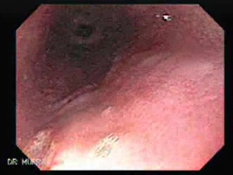 Pill Esophagitis - 3/5
