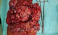 Gastrointestinal Stomal Tumor