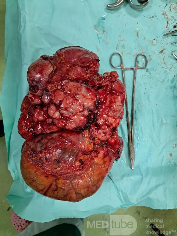 Gastrointestinal Stomal Tumor