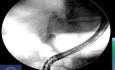 Overcoming the "Unpassable" Hilar Angulation During ERCP Stenting