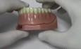 Implant Overdenture - Model Demonstration
