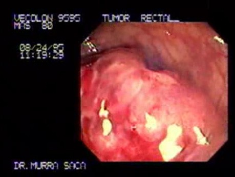 Enormous Sessile Adenoma of the Rectum (1 of 2)