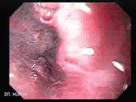Hemorrhage After Ligation - Variceal Cherry Red Spots
